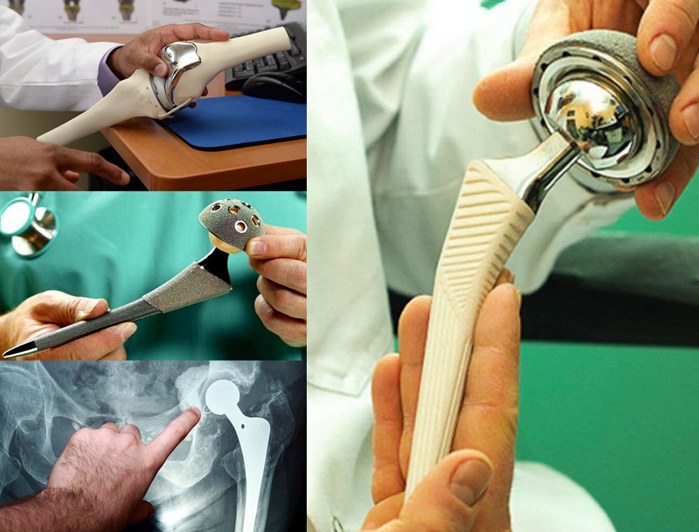 Эндопротез – буынның екінші өмірі