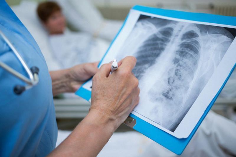 Атырауда 93 адам коронавирусқа шалдығып, 92 науқас сауығып шықты