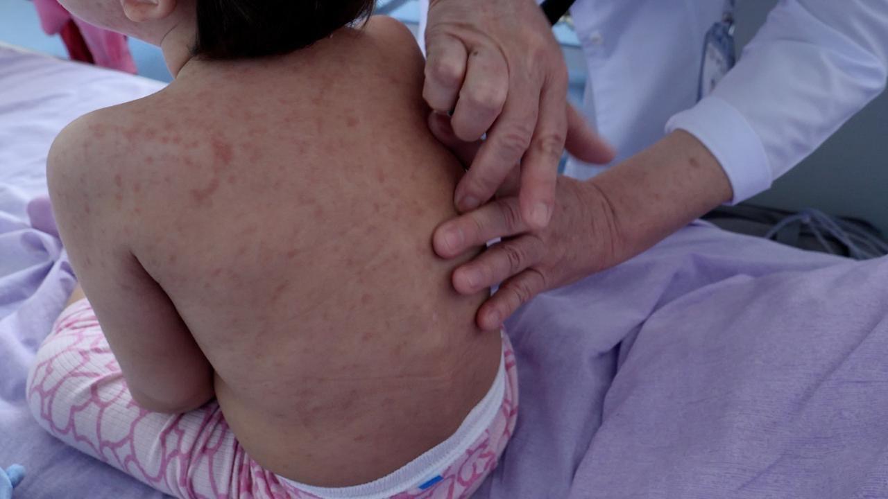 Елімізде қызылша жұқтыру көрсеткіші 30%-ға төмендеді